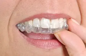 Get the perfect smile with invisible braces Sloan Dental
