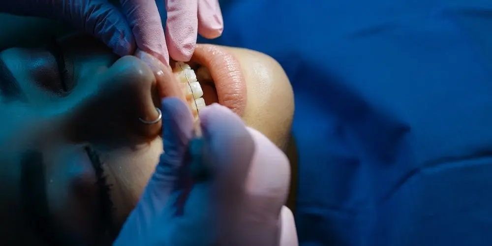 How Do I Know if I Need Braces