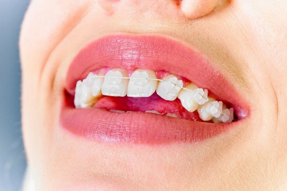 braces or veneers