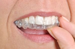 Get the perfect smile with invisible braces Sloan Dental