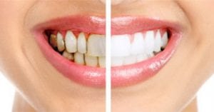 How to win the war against gum disease Sloan Dental