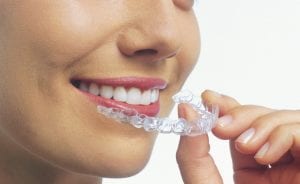 Invisalign®: The barely there brace Sloan Dental