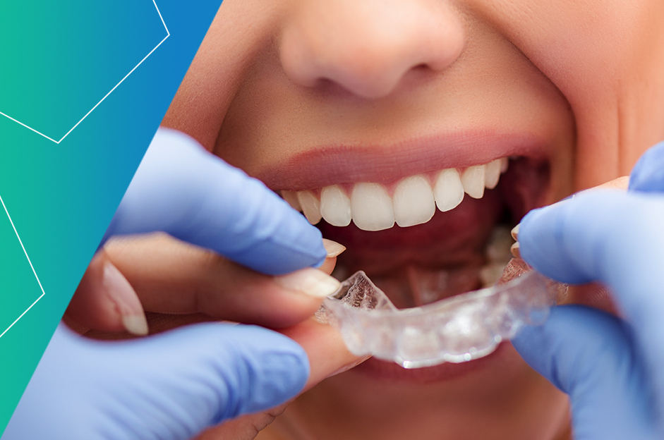 Why Invisalign Braces For Adults Are The Quick And Effective Option