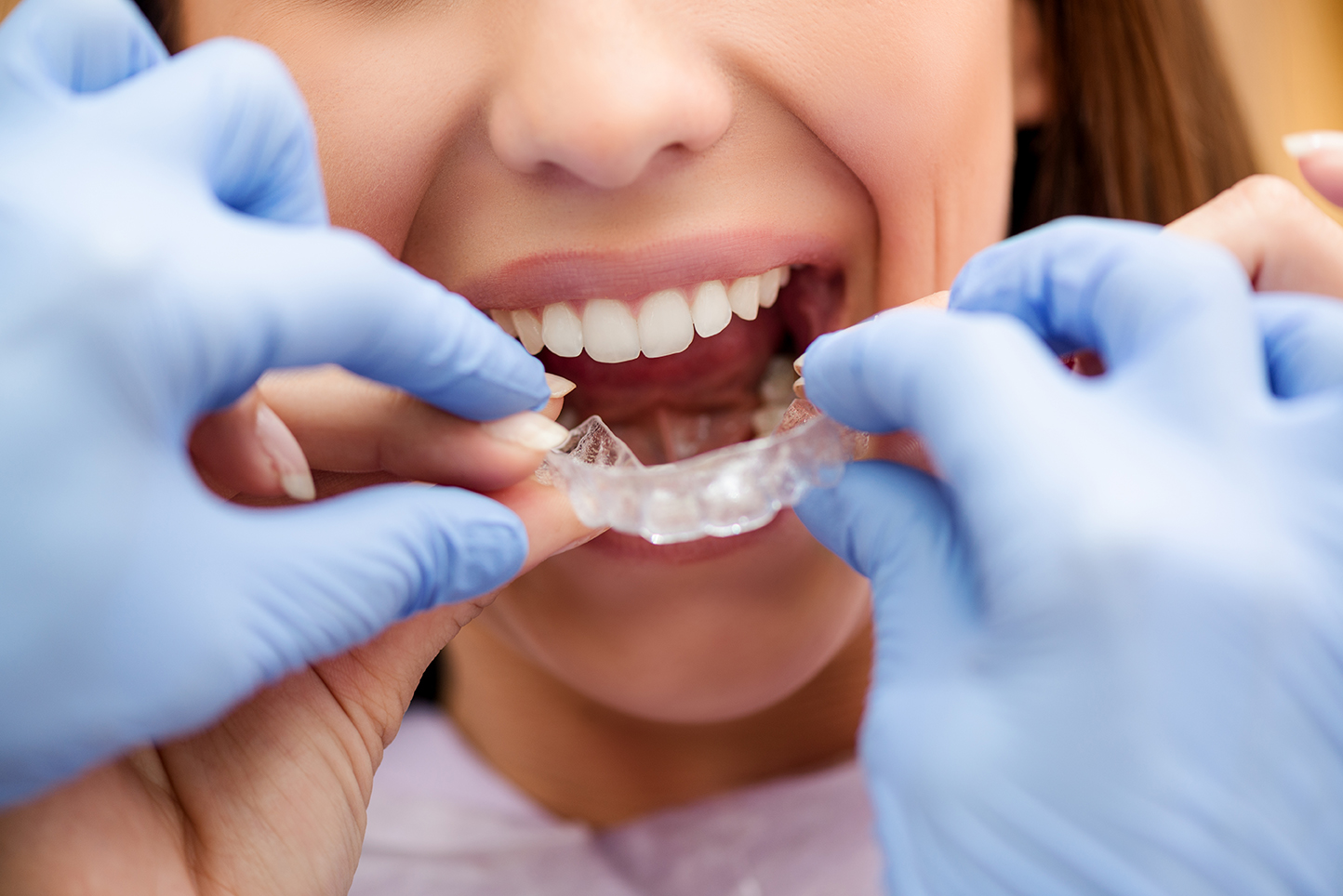 Why Invisalign Braces For Adults Are The Quick And Effective Option Sloan Dental