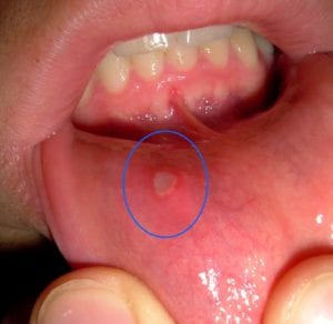 How to cure mouth ulcers at home Sloan Dental