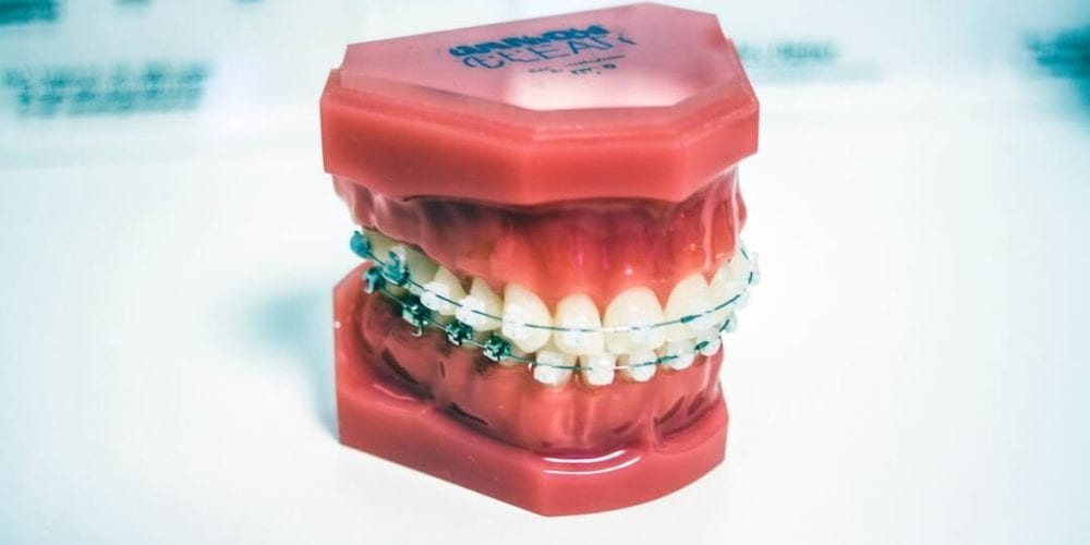 What to Expect After Braces