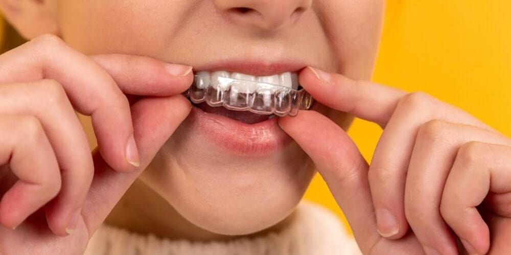 advantages and disadvantages of Invisalign and clear aligners