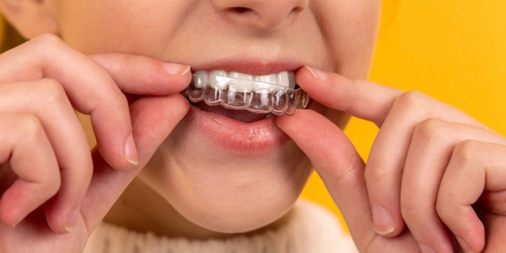 Invisalign hacks