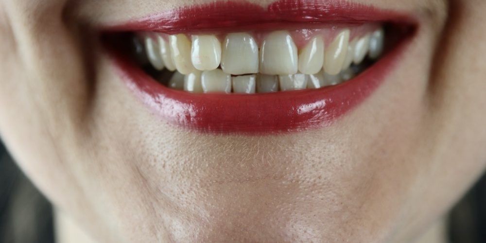 Why do teeth become crooked, and what's the best way to fix them