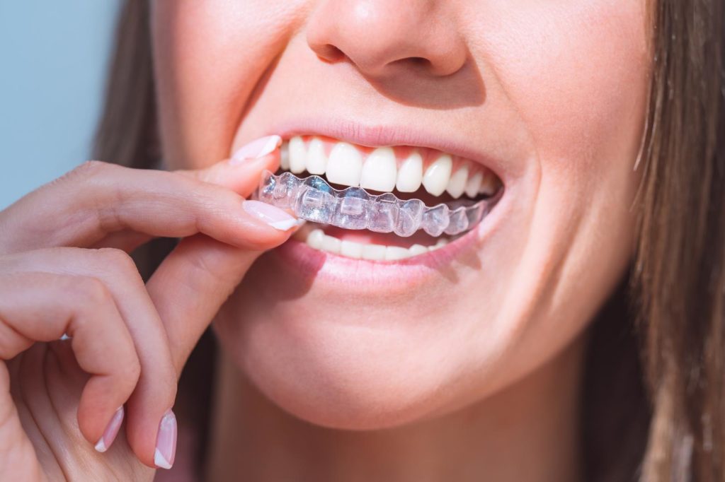 9 Common Myths You Should Stop Believing About Invisalign Braces Sloan Dental